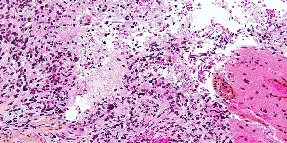 Pink Glioblastoma